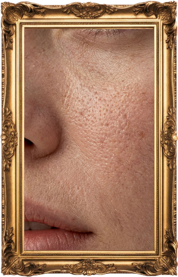 Microneedling